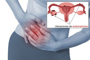 endometriosis